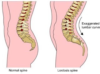 comparison of normal spine and Lordosis spine with its exaggerated lumbar curve